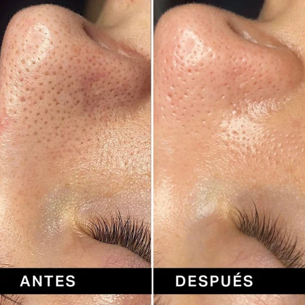 Extractor de Puntos Negros ClearSkin Pro®
