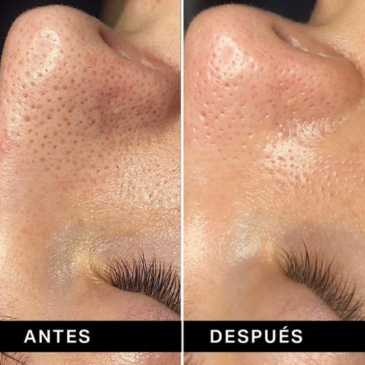 Extractor de Puntos Negros ClearSkin Pro®